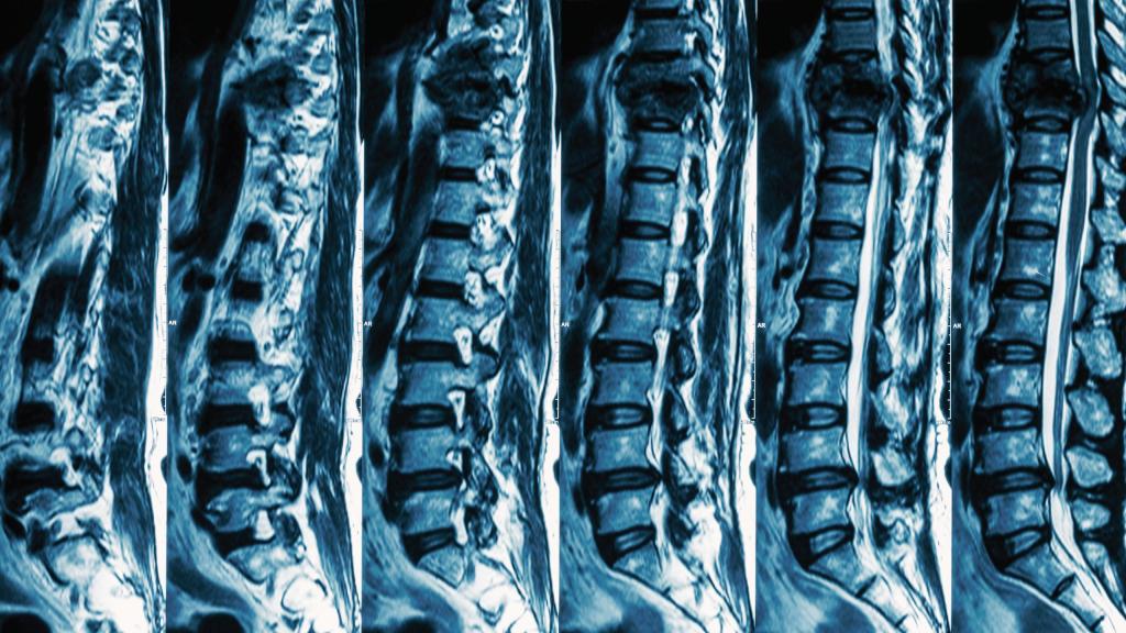 Spinal Cord Injury